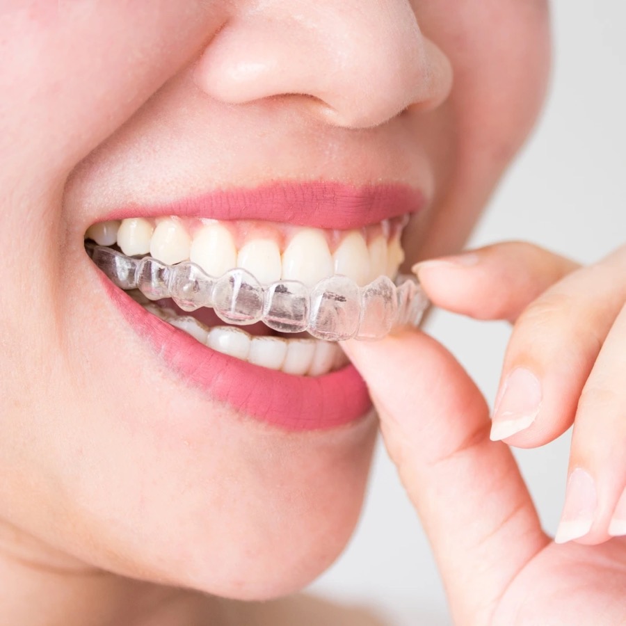 A patient placing a clear Invisalign aligner over her upper teeth
