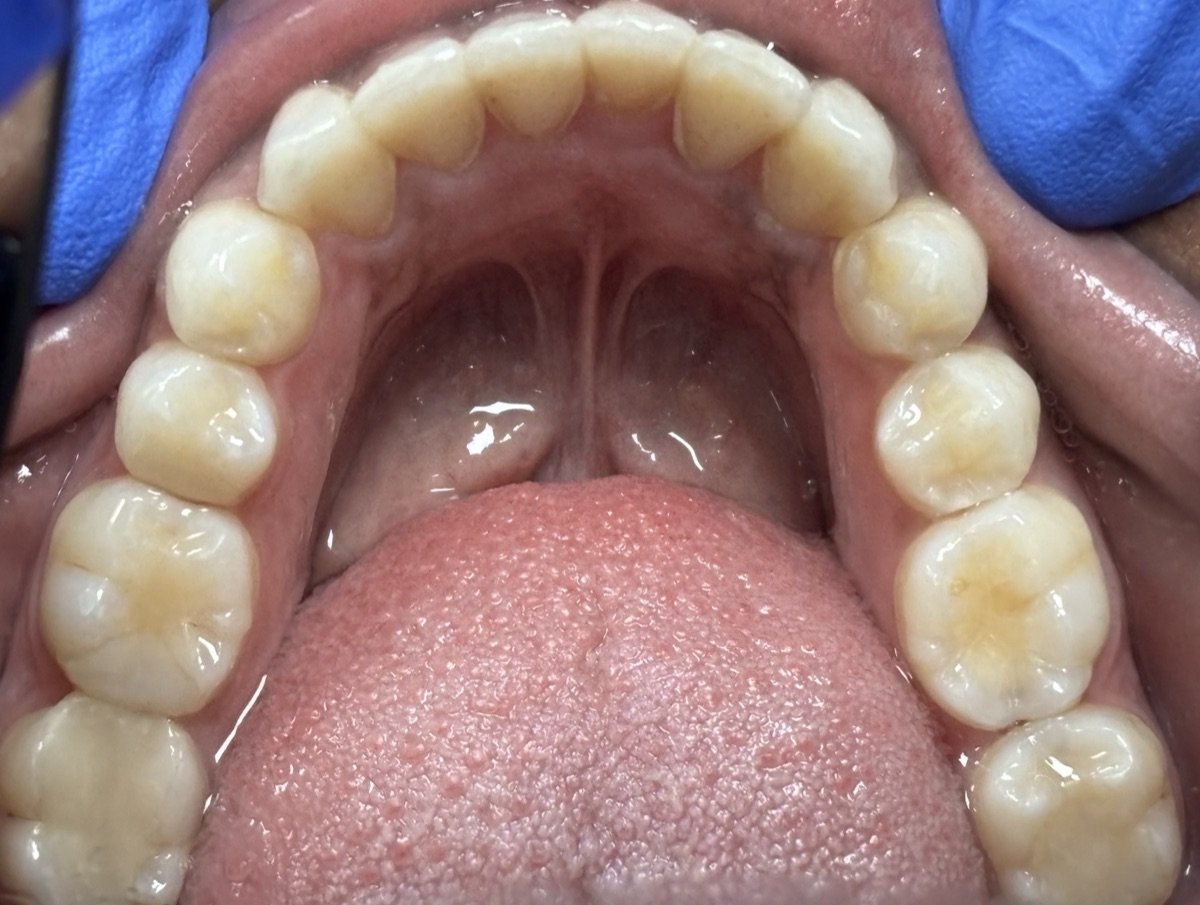 Lower teeth after Invisalign treatment at Hillcross