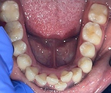 Lower teeth before Invisalign treatment at Hillcross
