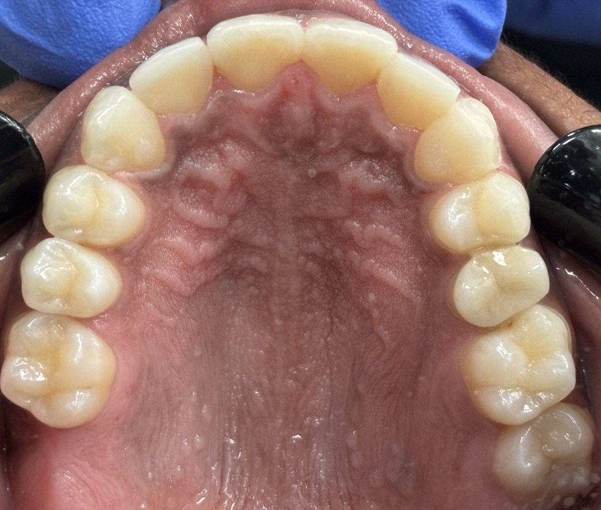 Upper teeth after Invisalign treatment at Hillcross