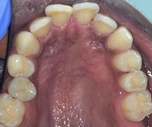 Upper teeth before Invisalign treatment at Hillcross